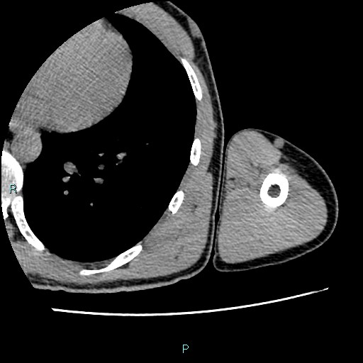 File:Avascular necrosis after fracture dislocations of the proximal humerus (Radiopaedia 88078-104655 D 118).jpg