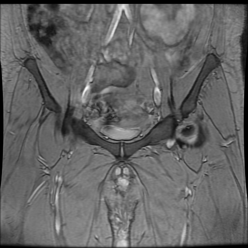 Avascular necrosis of the hip (Radiopaedia 61503-69465 F 21).jpg