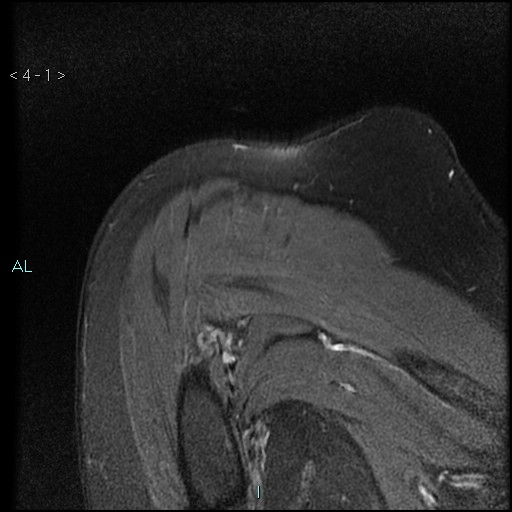 File:Avascular necrosis of the shoulder - Cruess stage I (Radiopaedia 77674-89886 Coronal PD fat sat 1).jpg