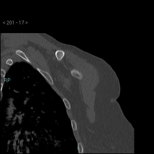 Avascular necrosis of the shoulder - Cruess stage I (Radiopaedia 77674-89887 Coronal bone window 16).jpg