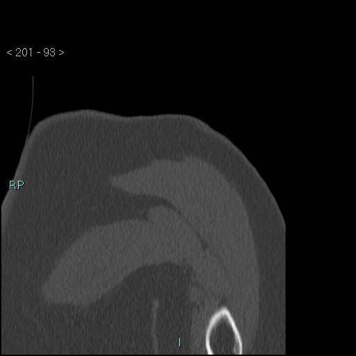 Avascular necrosis of the shoulder - Cruess stage I (Radiopaedia 77674-89887 Coronal bone window 92).jpg