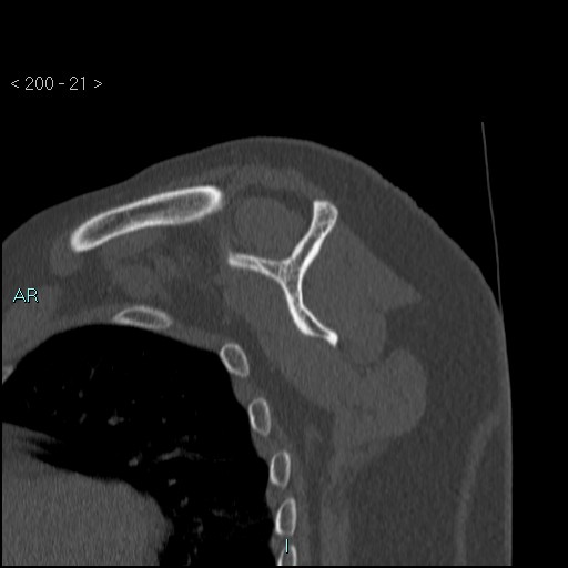 Avascular necrosis of the shoulder - Cruess stage I (Radiopaedia 77674-89887 Sagittal bone window 20).jpg