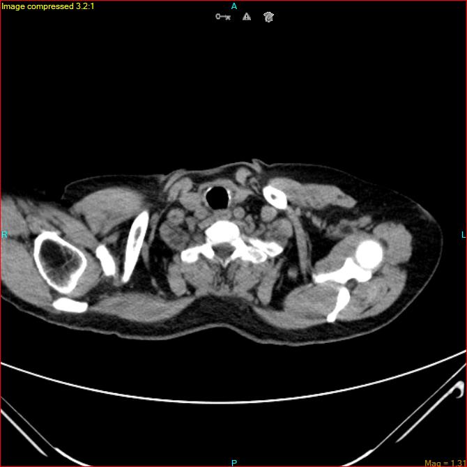 Azygos vein aneurysm (Radiopaedia 77824-90130 A 5).jpg