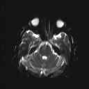 Balo concentric sclerosis (Radiopaedia 50458-55940 Axial DWI 16).jpg