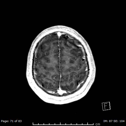 Balo concentric sclerosis (Radiopaedia 61637-69636 Axial T1 C+ 71).jpg