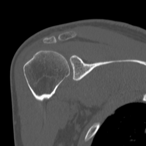 Bankart lesion (Radiopaedia 57256-64185 Coronal bone window 23).jpg