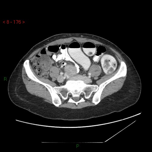 Bartholin gland cyst (Radiopaedia 54904-61181 A 44).jpg
