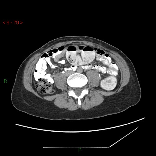 File:Bartholin gland cyst (Radiopaedia 54904-61181 Axial C+ delayed 20).jpg