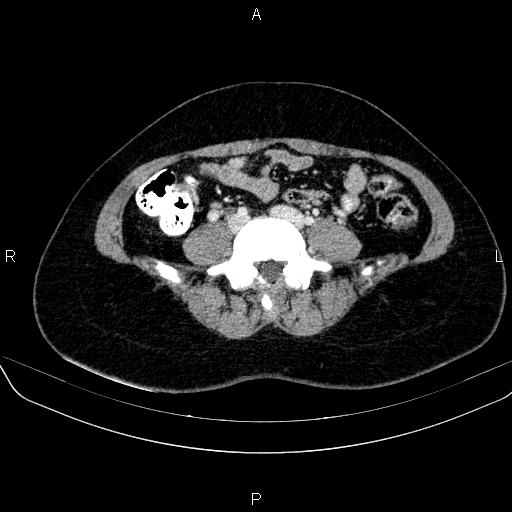 File:Bartholin gland cyst (Radiopaedia 62635-70930 Axial Post contrast 1).jpg