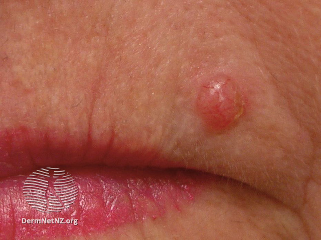 File:Basal cell carcinoma affecting the face (DermNet NZ lesions-bcc-face-1095).jpg