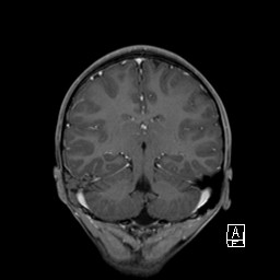 Base of skull rhabdomyosarcoma (Radiopaedia 32196-33142 I 46).jpg