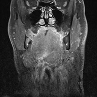 File:Base of tongue squamous cell carcinoma (Radiopaedia 31174-31884 E 11).jpg