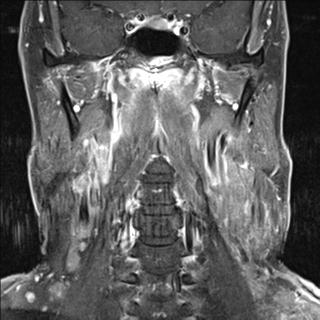 File:Base of tongue squamous cell carcinoma (Radiopaedia 31174-31884 E 3).jpg