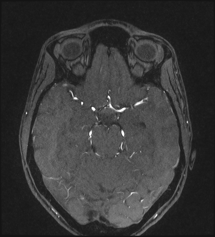 Basilar artery perforator aneurysm (Radiopaedia 82455-97733 Axial MRA 100).jpg