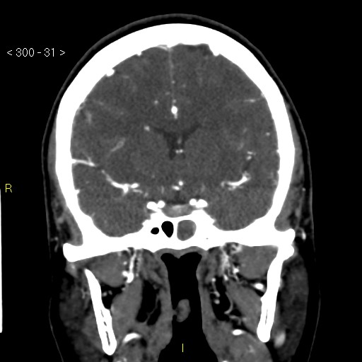 File:Basilar artery thrombosis (Radiopaedia 16260-15944 B 22).jpg