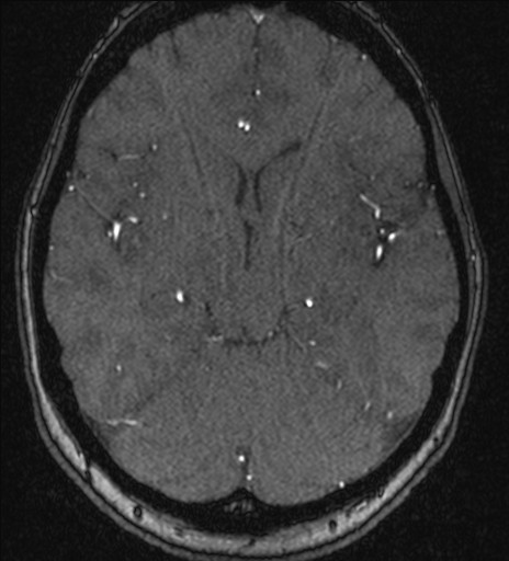 Basilar tip aneurysm (Radiopaedia 26504-26632 MRA 106).jpg