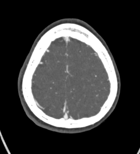 Basilar tip aneurysm with coiling (Radiopaedia 53912-60086 A 126).jpg