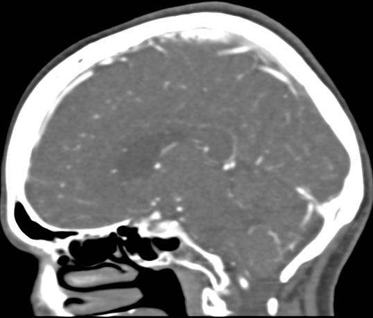Basilar tip aneurysm with coiling (Radiopaedia 53912-60086 C 73).jpg