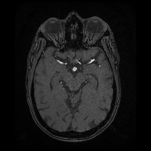 Basilar top and left middle cerebral artery aneurysm (Radiopaedia 61965-70031 Axial MRA 65).jpg