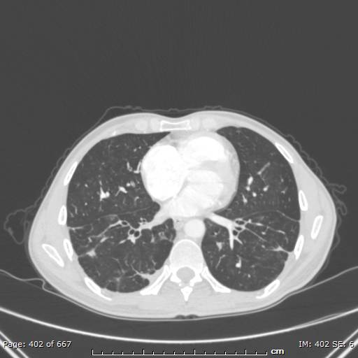 File:Behçet disease (Radiopaedia 44247-47889 Axial lung window 54).jpg