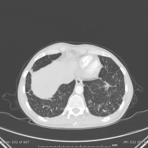 File:Behçet disease (Radiopaedia 44247-47889 Axial lung window 74).jpg
