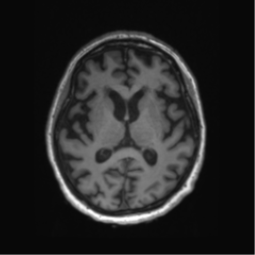 Behavioral variant frontotemporal dementia and late onset schizophrenia (Radiopaedia 52197-58083 Axial T1 47).png