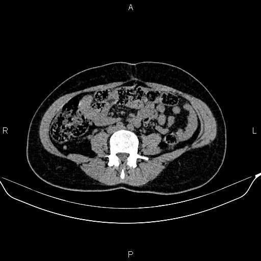 Benign adrenal adenoma (Radiopaedia 84166-99440 Axial non-contrast 58).jpg