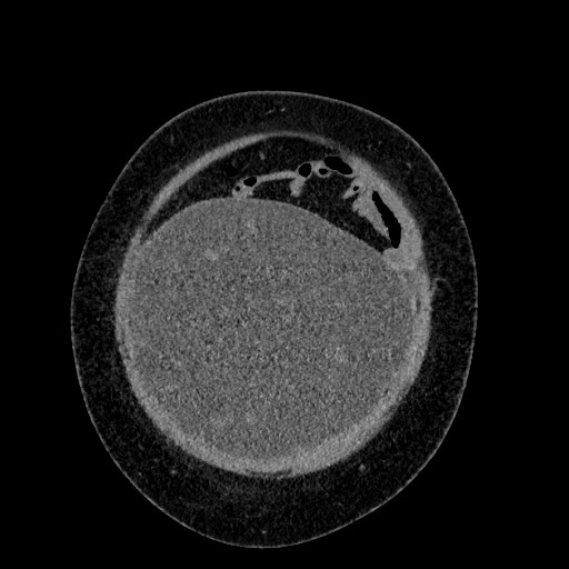 Benign leiomyoma with hydropic features (Radiopaedia 89250-106130 B 21).jpg