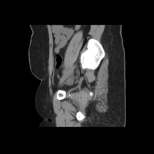 File:Bicornuate uterus- on MRI (Radiopaedia 49206-54296 A 17).jpg