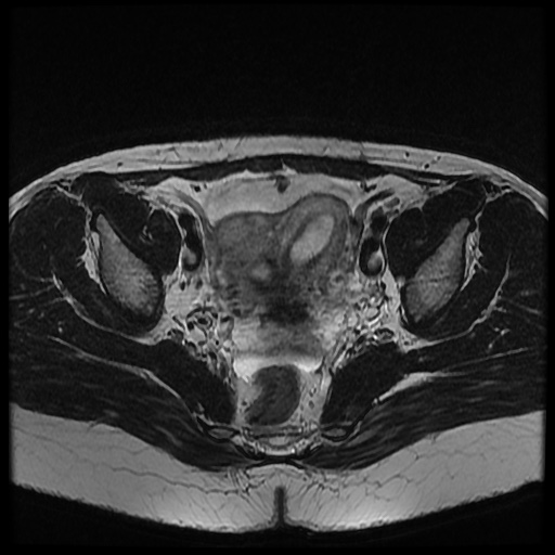 File:Bicornuate uterus (Radiopaedia 51676-57472 Axial T2 19).jpg