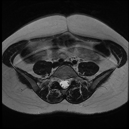 File:Bicornuate uterus (Radiopaedia 51676-57472 Axial T2 33).jpg