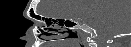 Bilateral Ectopic Infraorbital Nerves (Radiopaedia 49006-54084 Sagittal bone window 22).jpg