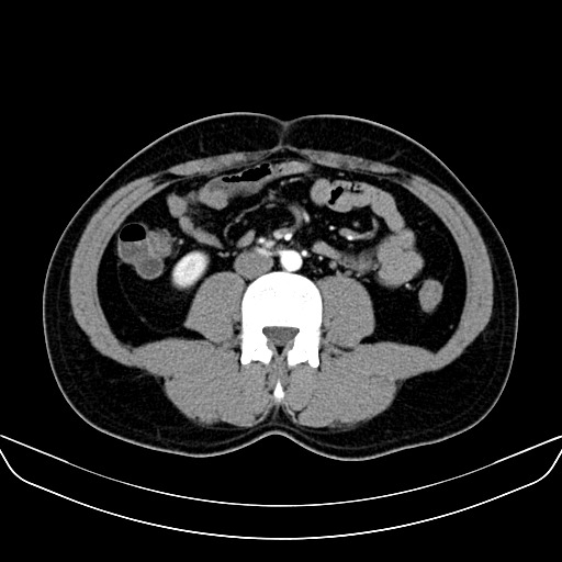 Bilateral accessory renal arteries with mild pelvi-ureteric junction (PUJ) obstruction (Radiopaedia 66357-75596 A 35).jpg