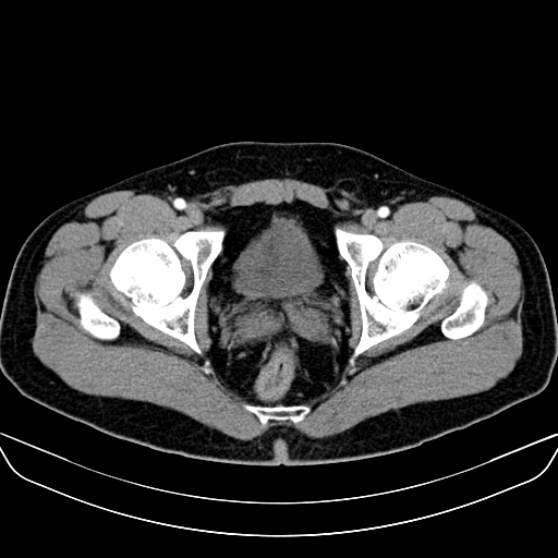 Bilateral accessory renal arteries with mild pelvi-ureteric junction (PUJ) obstruction (Radiopaedia 66357-75596 A 71).jpg