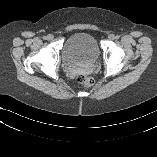 Bilateral acetabular protrusion with pincer type femoro-acetabular impingement (Radiopaedia 30134-30733 AXIAL SOFT THIN 45).jpg