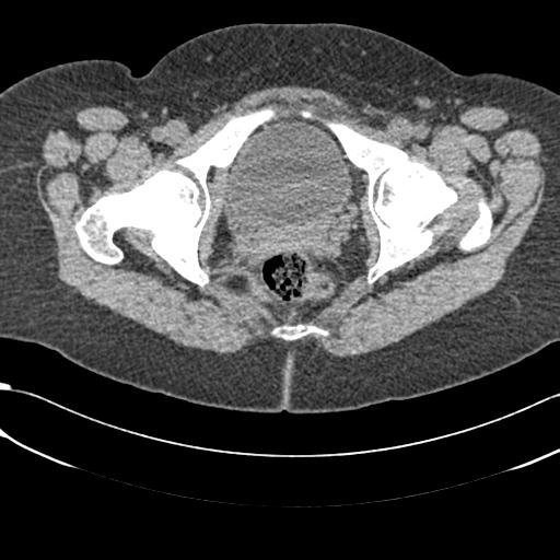 File:Bilateral acetabular protrusion with pincer type femoro-acetabular impingement (Radiopaedia 30134-30733 AXIAL SOFT THIN 52).jpg