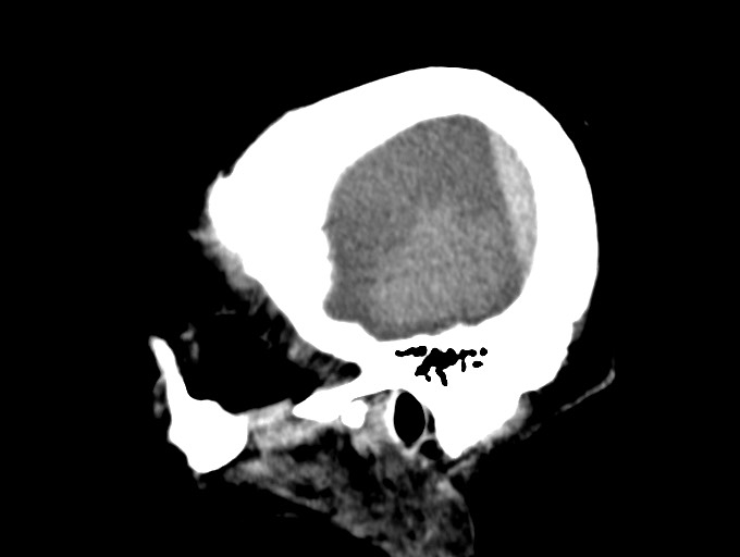 Bilateral acute on chronic subdural hematomas (Radiopaedia 78466-91146 C 11).jpg