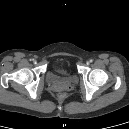 Bilateral adrenal gland hyperenhancement in pancreatitis (Radiopaedia 86642-102753 E 107).jpg