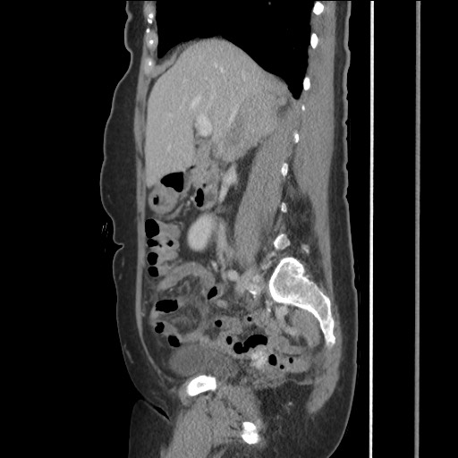 Bilateral adrenal granulocytic sarcomas (chloromas) (Radiopaedia 78375-91007 C 59).jpg