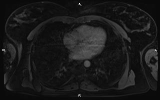 Bilateral adrenal myelolipoma (Radiopaedia 63058-71537 G 3).jpg