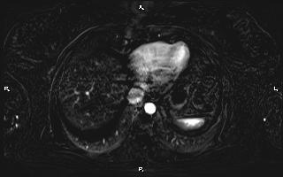 Bilateral adrenal myelolipoma (Radiopaedia 63058-71537 I 13).jpg