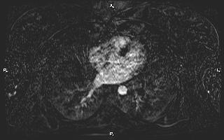 Bilateral adrenal myelolipoma (Radiopaedia 63058-71537 I 2).jpg
