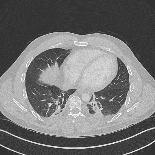 Bilateral atelectasis (Radiopaedia 48666-53675 Axial lung window 76).jpg