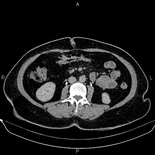Bilateral benign adrenal adenomas (Radiopaedia 86912-103124 Axial C+ delayed 78).jpg