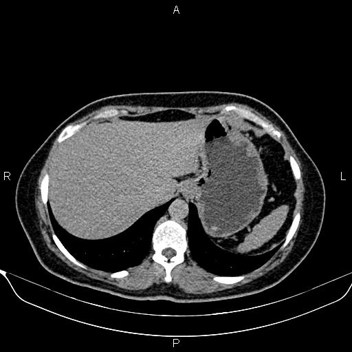 Bilateral benign adrenal adenomas (Radiopaedia 86912-103124 Axial C+ delayed 9).jpg