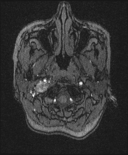 Bilateral carotid body tumors and right glomus jugulare tumor (Radiopaedia 20024-20060 Axial MRA 10).jpg