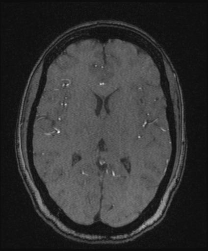 Bilateral carotid body tumors and right glomus jugulare tumor (Radiopaedia 20024-20060 Axial MRA 102).jpg