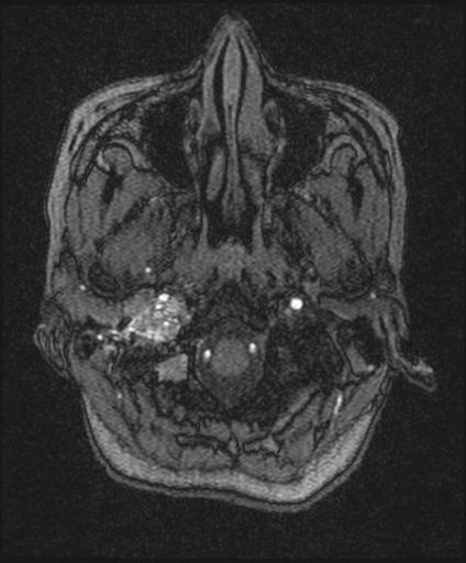 Bilateral carotid body tumors and right glomus jugulare tumor (Radiopaedia 20024-20060 Axial MRA 18).jpg