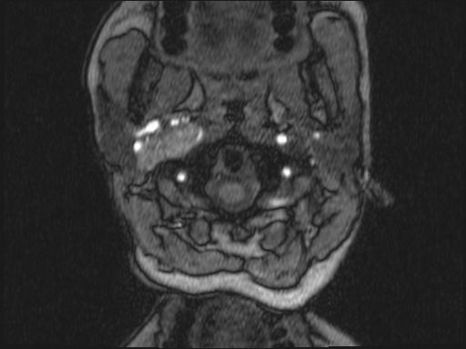 Bilateral carotid body tumors and right glomus jugulare tumor (Radiopaedia 20024-20060 Axial MRA 287).jpg