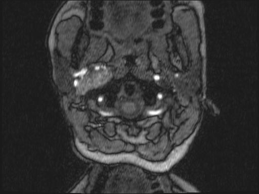 Bilateral carotid body tumors and right glomus jugulare tumor (Radiopaedia 20024-20060 Axial MRA 288).jpg